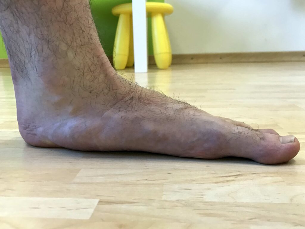 foot reconstruction surgery