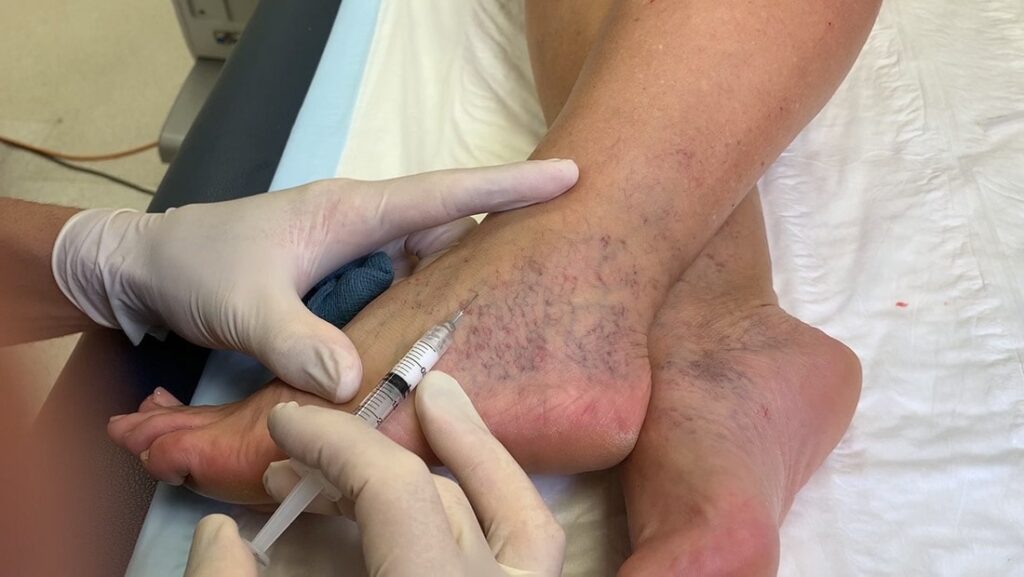 Pictures of Trapped Blood After Sclerotherapy