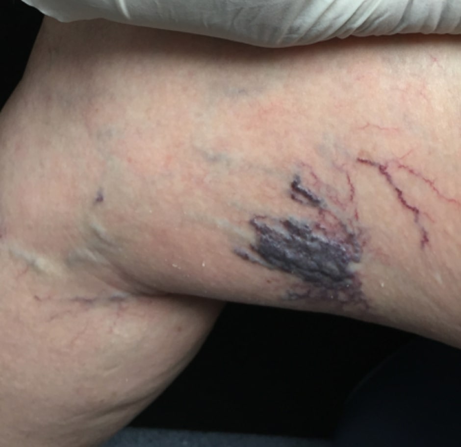 5 Real Pictures of Trapped Blood After Sclerotherapy & FAQs!