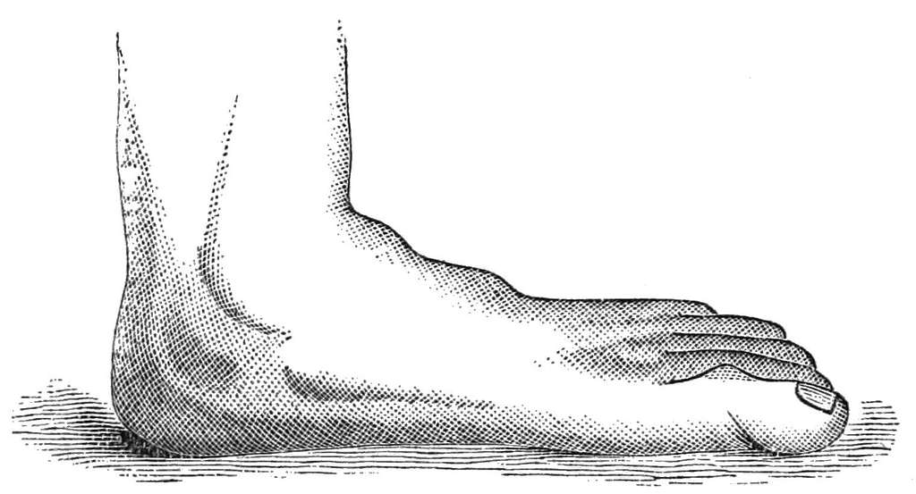 Cons of Flat Feet Surgery